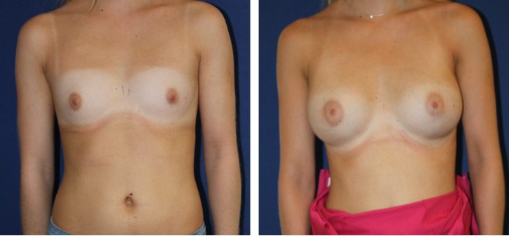 Implants mammaires ergonomiques 295 cc, augmentation mammaire — photo avant et après, Dr Armand Azencot, Bordeaux