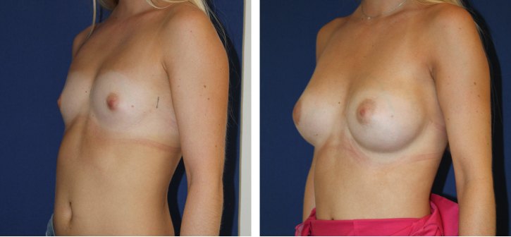 Implants mammaires ergonomiques 295 cc, autre incidence — photo avant et après, Dr Armand Azencot, Bordeaux