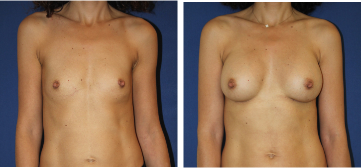 Augmentation mammaire, implants mammaires — photo avant et après, Dr Armand Azencot, Bordeaux