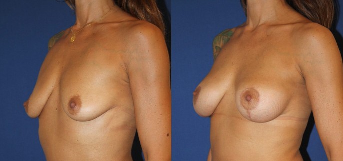 Mastopexie et augmentation mammaire, implants ergonomiques profil moyen 160 cc — photo avant et après, Dr Armand Azencot, Bordeaux