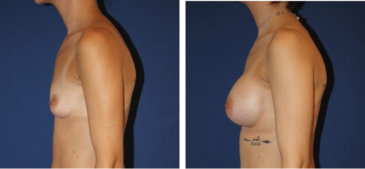Implants mammaires ergonomiques 340 cc, voie sous-mammaire — photo avant et après, Dr Armand Azencot, Bordeaux