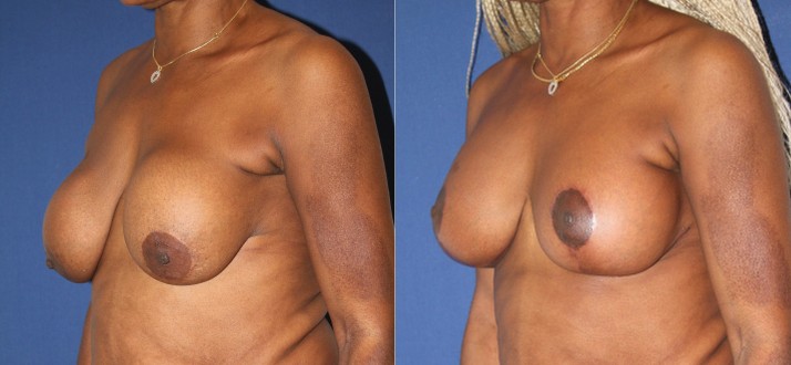 Remplacement d’implants mammaires, avec mastopexie — photo avant et après, Dr Armand Azencot, Bordeaux