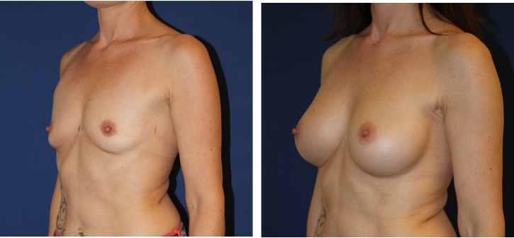 Implants mammaires anatomiques 305 cc, voie axillaire — photo avant et après, Dr Armand Azencot, Bordeaux