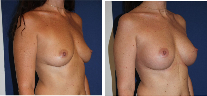 Implants mammaires ergonomiques 310 cc, augmentation mammaire — photo avant et après, Dr Armand Azencot, Bordeaux