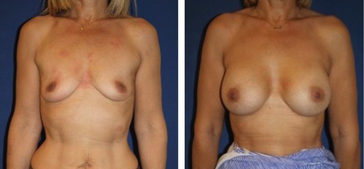 Implants mammaires 300 cc, augmentation mammaire — photo avant et après, Dr Armand Azencot, Bordeaux
