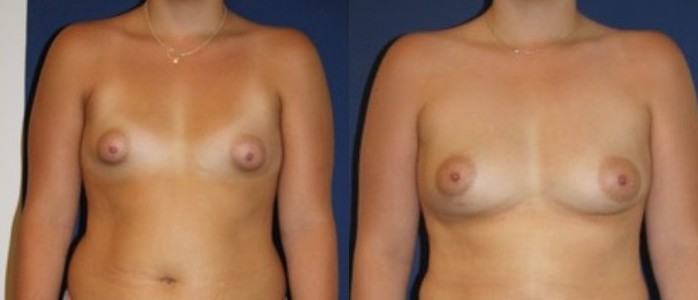 Tuberous breast malformation, malformation correction — before and after photo, Dr Armand Azencot, Bordeaux