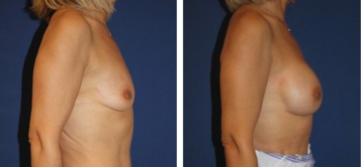 Implants mammaires 300 cc, autre incidence — photo avant et après, Dr Armand Azencot, Bordeaux