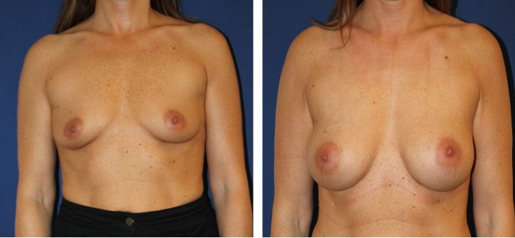 Augmentation mammaire composite, implant et transfert graisseux — photo avant et après, Dr Armand Azencot, Bordeaux