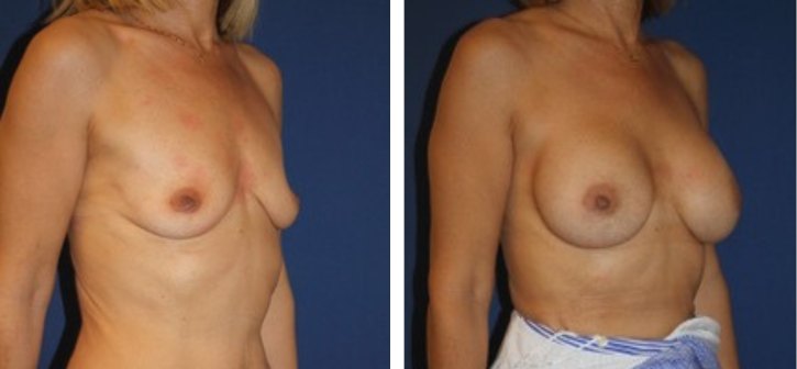 Implants mammaires 300 cc, autre incidence — photo avant et après, Dr Armand Azencot, Bordeaux
