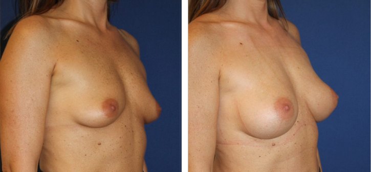 Augmentation mammaire composite, autre incidence — photo avant et après, Dr Armand Azencot, Bordeaux