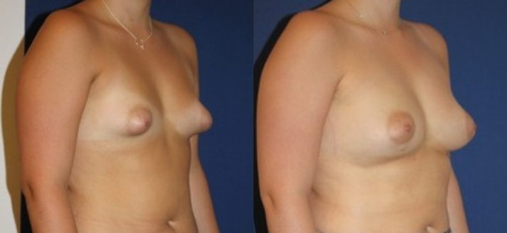 Tuberous breast malformation, another view — before and after photo, Dr Armand Azencot, Bordeaux