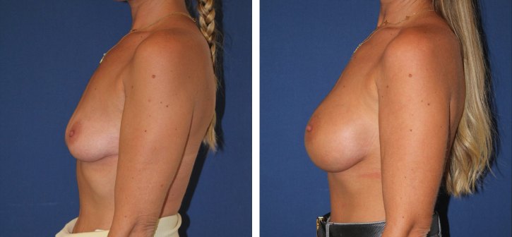 Implants mammaires ergonomiques 390 cc, autre incidence — photo avant et après, Dr Armand Azencot, Bordeaux
