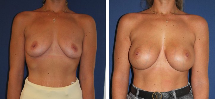 Implants mammaires ergonomiques 390 cc, augmentation mammaire — photo avant et après, Dr Armand Azencot, Bordeaux