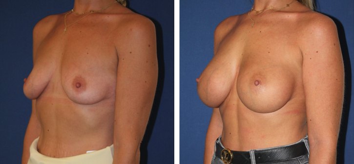 Implants mammaires ergonomiques 390 cc, autre incidence — photo avant et après, Dr Armand Azencot, Bordeaux