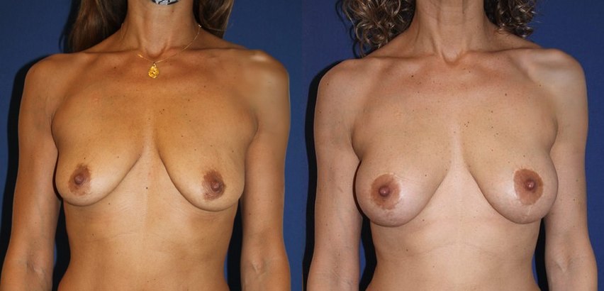 Mastopexy and ergonomic implants, 240 cc, breast lift — before and after photo, Dr Armand Azencot, Bordeaux