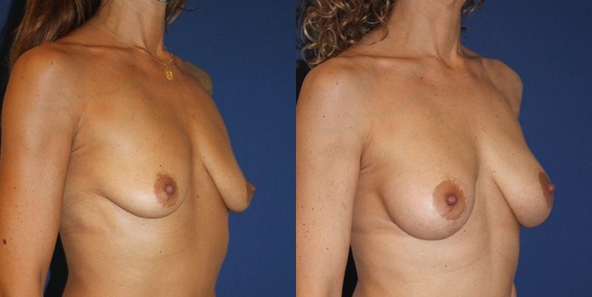 Mastopexy and ergonomic implants, 240 cc, another view — before and after photo, Dr Armand Azencot, Bordeaux
