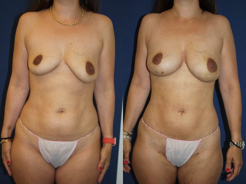 Lipofilling exclusif, 500 cc par sein, une séance — photo avant et après, Dr Armand Azencot, Bordeaux