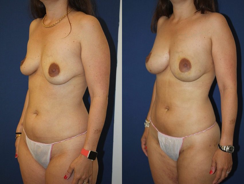 Lipofilling exclusif, 500 cc par sein, autre incidence — photo avant et après, Dr Armand Azencot, Bordeaux