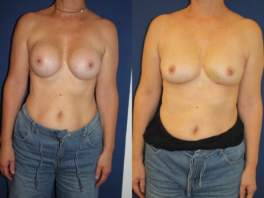 Retrait d’implants, conversion autologue, injection de graisse, 400 cc — photo avant et après, Dr Armand Azencot, Bordeaux