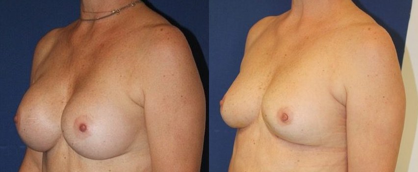 Implant removal, autologous conversion, another view — before and after photo, Dr Armand Azencot, Bordeaux