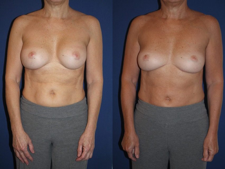 Retrait d’implants 240 cc, conversion autologue, injection de graisse, 190 cc — photo avant et après, Dr Armand Azencot, Bordeaux