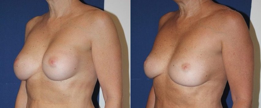 240 cc implant removal, autologous conversion, another view — before and after photo, Dr Armand Azencot, Bordeaux