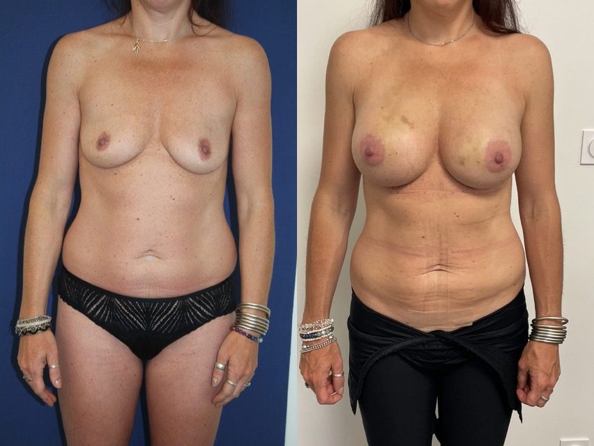 Augmentation composite, implants ergonomiques 340 cc, lipofilling 215 cc par sein — photo avant et après, Dr Armand Azencot, Bordeaux