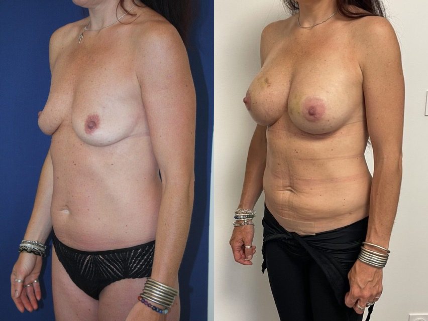 Augmentation composite, implants ergonomiques 340 cc, autre incidence — photo avant et après, Dr Armand Azencot, Bordeaux