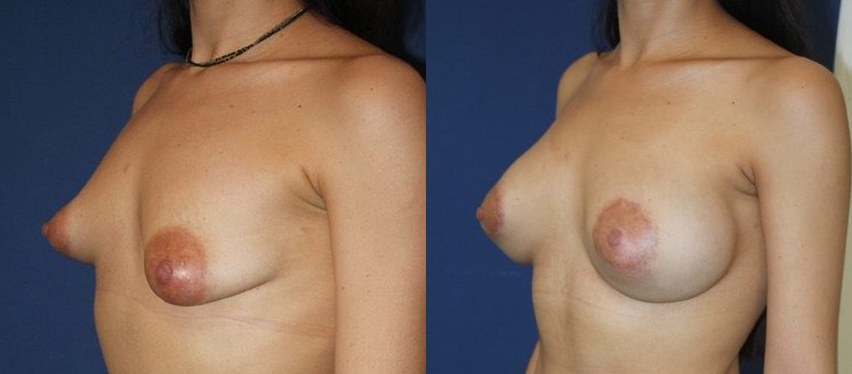 Tuberous breasts, ergonomic implants 285 cc, another view — before and after photo, Dr Armand Azencot, Bordeaux