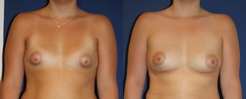 Tuberous breasts, fat remodelling only, 450 cc, one session — before and after photo, Dr Armand Azencot, Bordeaux