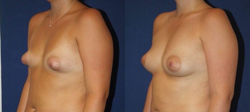 Tuberous breasts, fat remodelling only, 450 cc, another view — before and after photo, Dr Armand Azencot, Bordeaux