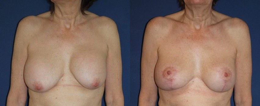Breast implant replacement with mastopexy, ergonomic implants, 320 cc — before and after photo, Dr Armand Azencot, Bordeaux