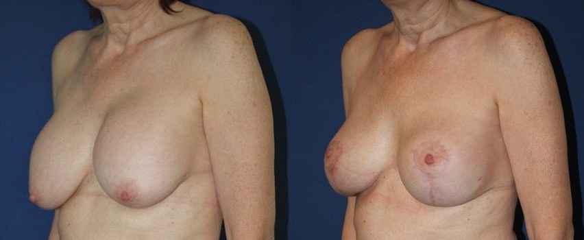 Breast implant replacement with mastopexy, another view — before and after photo, Dr Armand Azencot, Bordeaux