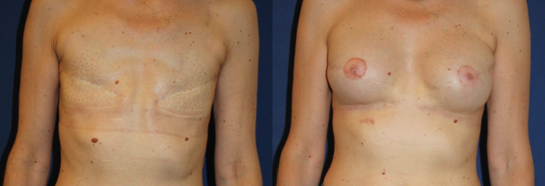 Bilateral delayed breast reconstruction, a2x-295 implants, 250 cc fat remodelling per breast, nipple-areola complex — before and after photo, Dr Armand Azencot, Bordeaux