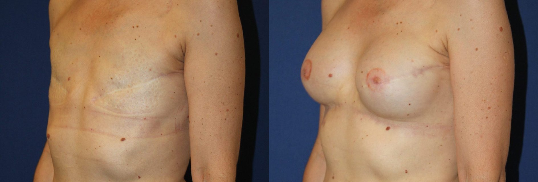 Bilateral delayed breast reconstruction, another view — before and after photo, Dr Armand Azencot, Bordeaux