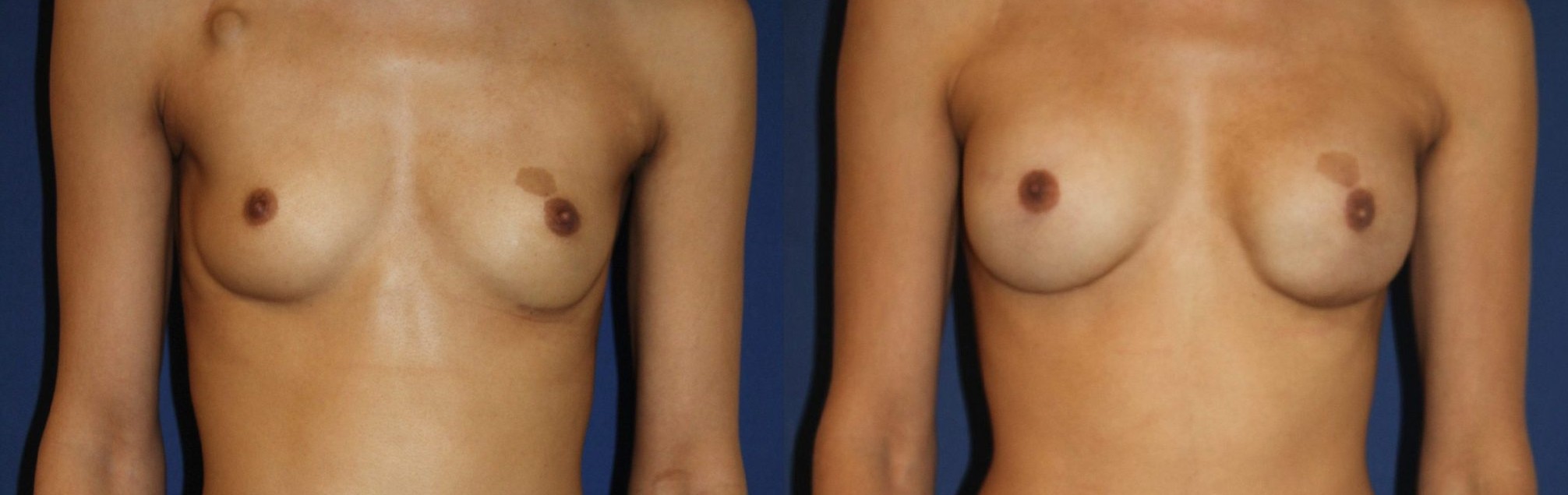 Bilateral reconstruction, curative on the left and prophylactic on the right, ersd-320 implants, bilateral fat remodelling, 200 cc per breast — before and after photo, Dr Armand Azencot, Bordeaux