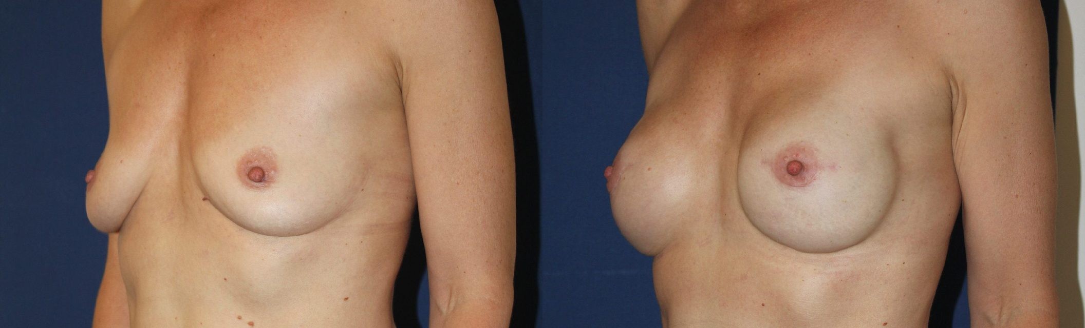 Bilateral prophylactic mastectomy, immediate reconstruction, another view — before and after photo, Dr Armand Azencot, Bordeaux