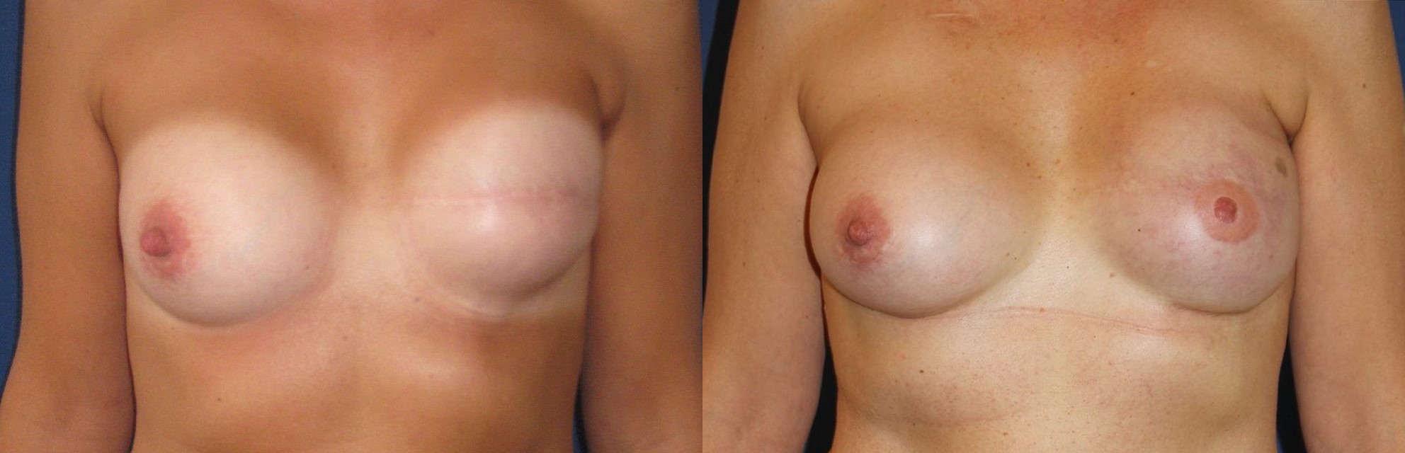 Left breast reconstruction revision and right breast augmentation, a2x-295 and an-165 implant replacement, fat remodelling — before and after photo, Dr Armand Azencot, Bordeaux