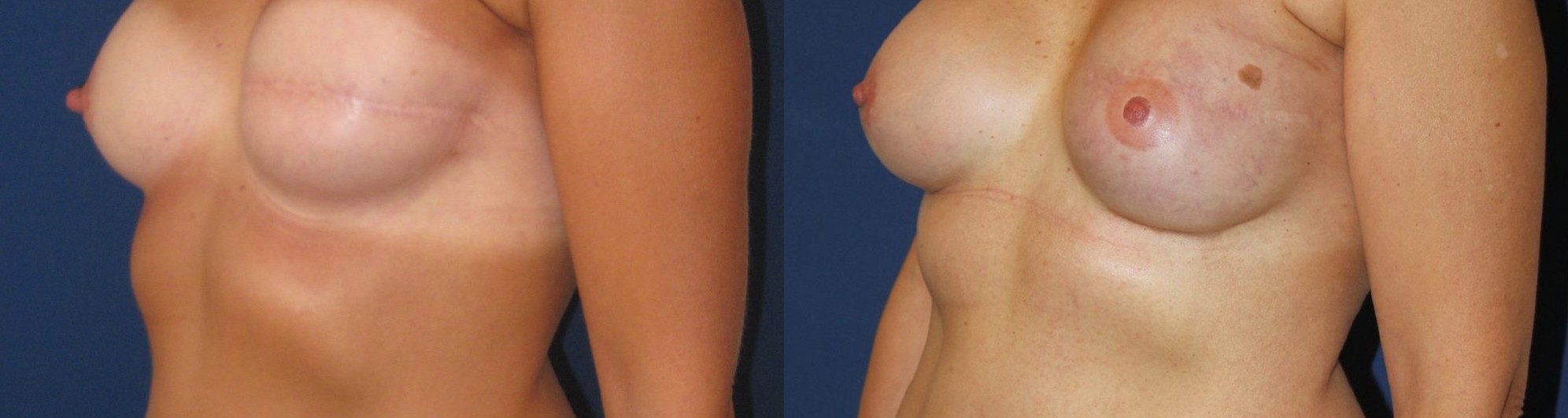 Left breast reconstruction revision and right breast augmentation, another view — before and after photo, Dr Armand Azencot, Bordeaux