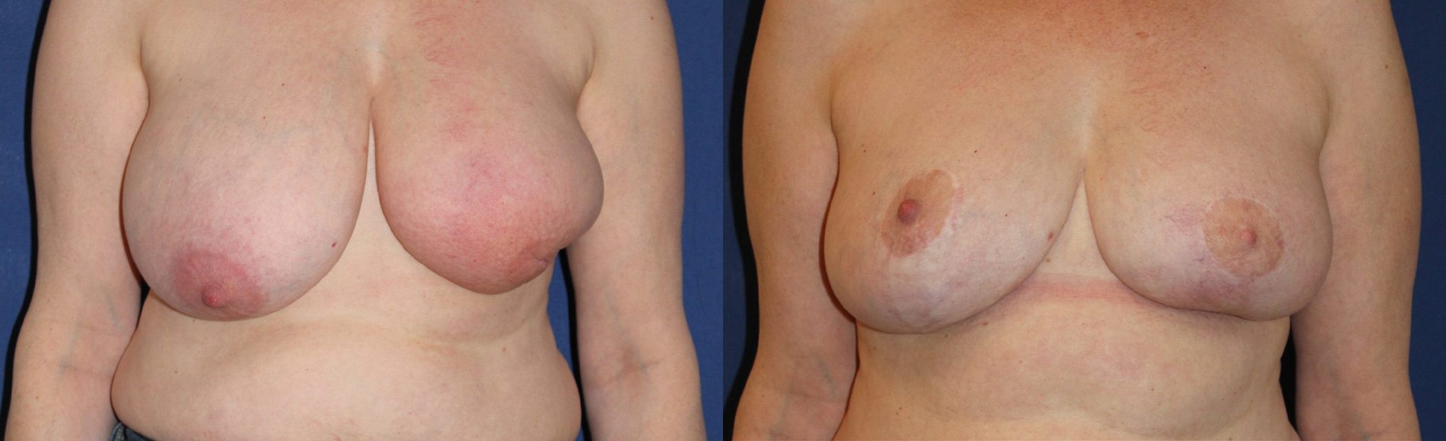 Correction of breast-conserving treatment sequelae, left breast, right mammaplasty — before and after photo, Dr Armand Azencot, Bordeaux