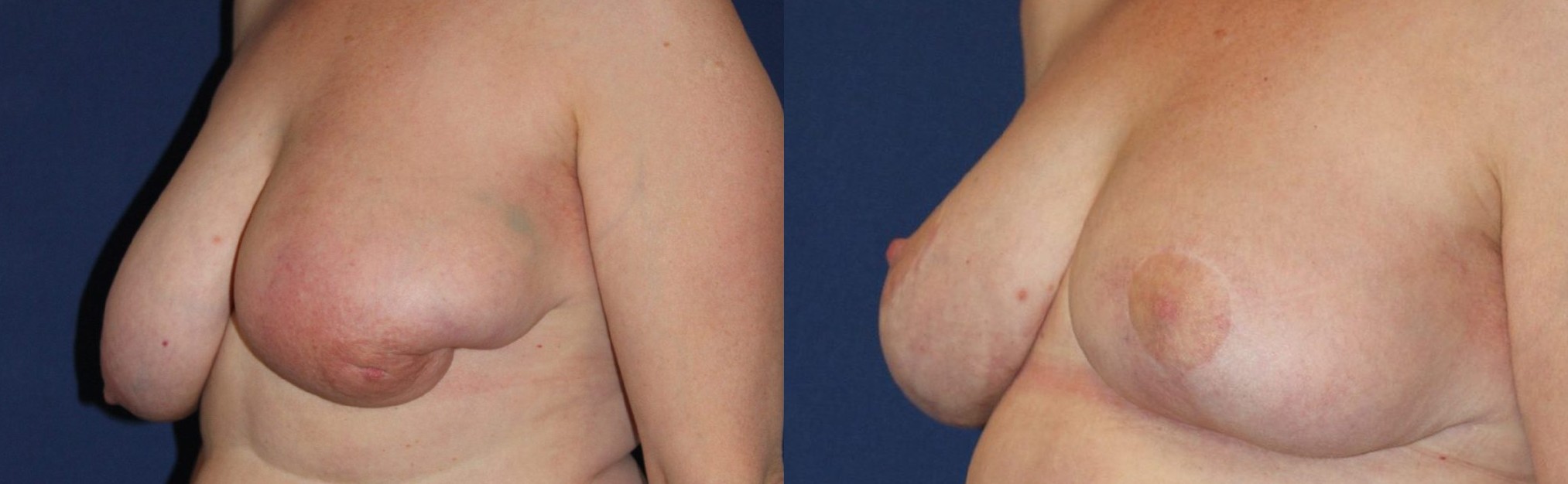 Correction of breast-conserving treatment sequelae, left breast, right mammaplasty, another view — before and after photo, Dr Armand Azencot, Bordeaux