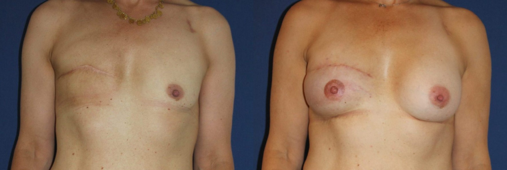 Delayed right breast reconstruction with an anatomical implant, fat remodelling and nipple-areola complex reconstruction. — before and after photo, Dr Armand Azencot, Bordeaux