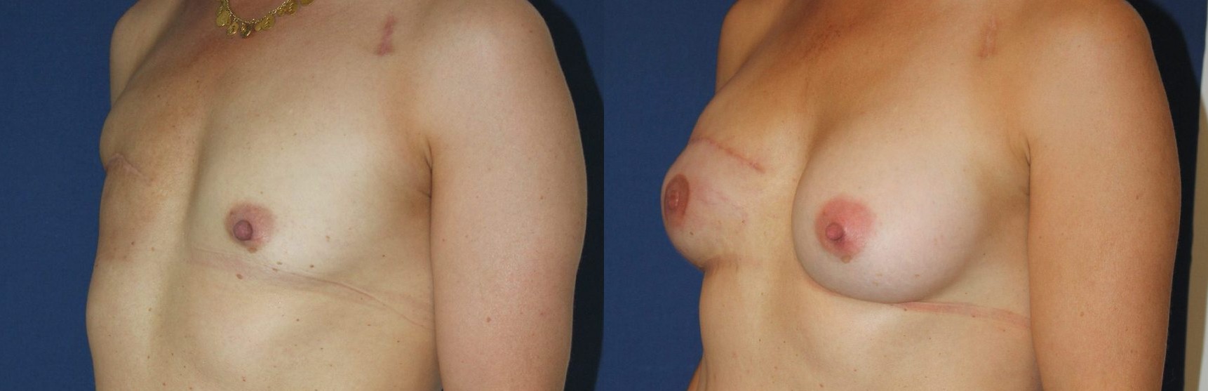 Delayed right breast reconstruction with an anatomical implant, another view — before and after photo, Dr Armand Azencot, Bordeaux